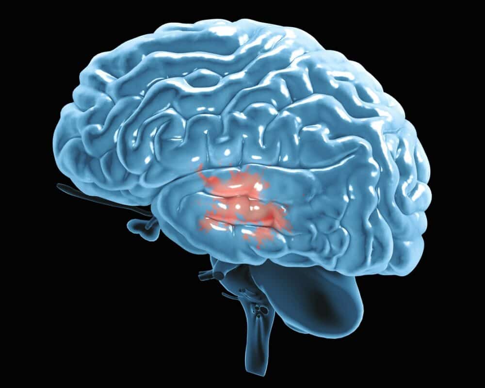 Azathioprine in Parkinson's